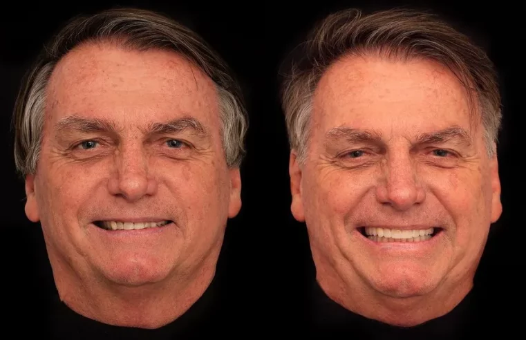 ANTES E DEPOIS: JAIR BOLSONARO REALIZA PROCEDIMENTO ESTÉTICO