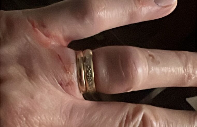 IDOSA NÃO CONSEGUE TIRAR ALIANÇA DO DEDO E É MORDIDA E CHUTADA POR ASSALTANTES EM SÃO PAULO