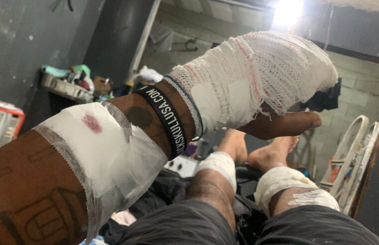 CACHORRO ABANDONADO EM SÃO BERNARDO MORDE SETE PESSOAS NO IRAJÁ