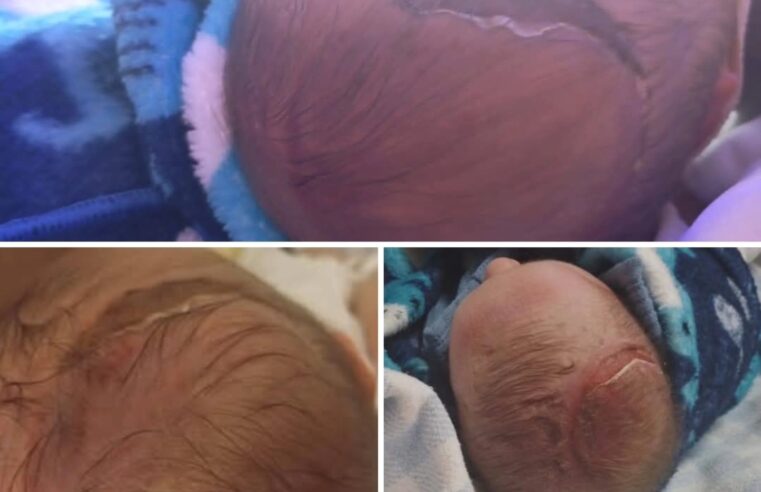 LESÃO NA CABEÇA DE BEBÊ APÓS PARTO NO HOSPITAL DA MULHER COMOVE A INTERNET; PREFEITURA DE SÃO BERNARDO EXPLICA O CASO