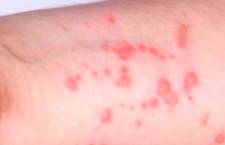 CASO SUSPEITO DE MPOX É INVESTIGADO NA UPA VILA LUZITA, EM SANTO ANDRÉ