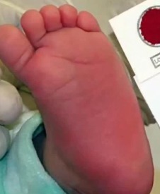 SÃO CAETANO DO SUL AMPLIA TESTE DO PEZINHO PARA DETECTAR 52 DOENÇAS E UNIVERSALIZA TRIAGEM NEONATAL
